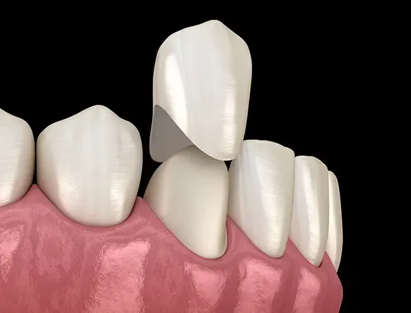 A dental crown being placed on a front tooth, highlighting the precise fit and restoration process.
