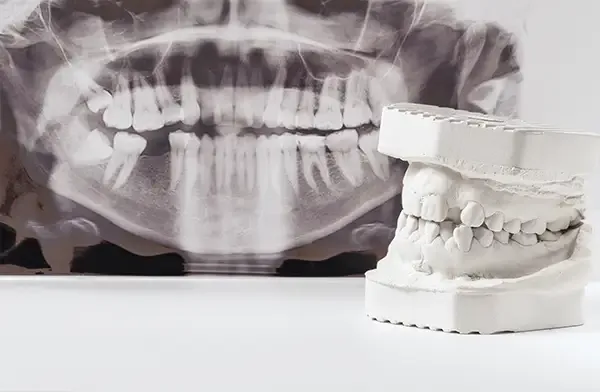 A dental model placed next to a panoramic X-ray, illustrating full-mouth restoration planning.