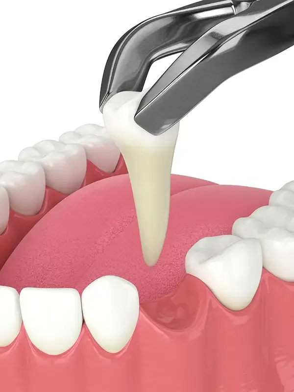 A dental tool extracting a front tooth from the gum, focusing on the roots and oral tissue.