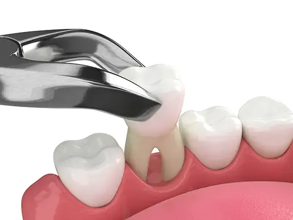 A dental tool extracting a tooth from the lower gum line, highlighting oral anatomy during the procedure.