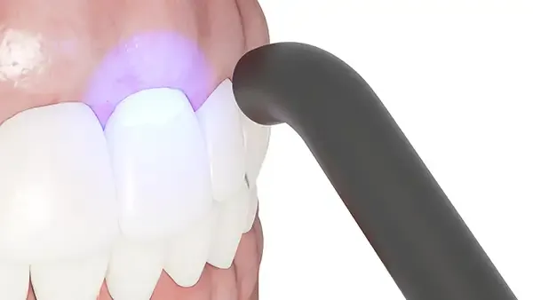 Close-up of a dental bonding procedure using a curing light to harden the composite material on a patient’s teeth.
