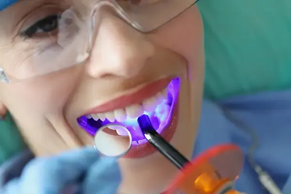 Close-up of a dentist applying a dental sealant to a patient’s teeth using a curing light, with the patient wearing protective glasses.