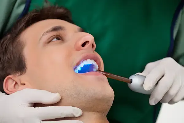 A dentist using a curing light to apply a dental sealant on a male patient’s teeth during a dental procedure in a clinic.
