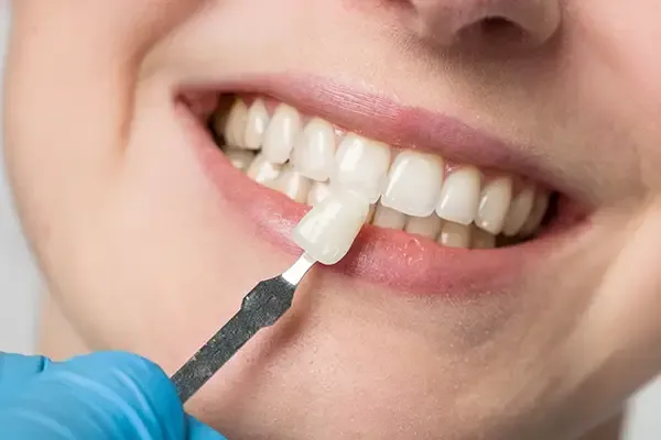 Dentist using a precise shade matching tool to select the ideal dental veneer for a smiling patient’s teeth.