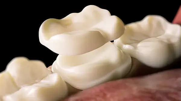 Close-up of a dental onlay being placed on a tooth, showcasing precise restorative dentistry techniques.