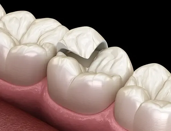 A dental onlay being fitted onto a prepared tooth, demonstrating the restoration process.