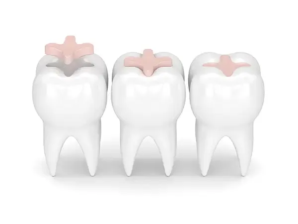 Tooth-colored inlays, showing how they blend seamlessly with natural teeth for a restorative solution.