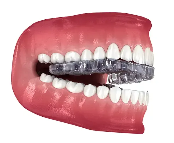 A mouth guard fitted on upper and lower teeth, highlighting teeth protection during grinding.