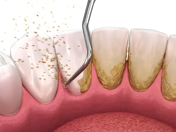 Close-up of a dental scaler removing tartar buildup from teeth during a periodontal cleaning procedure.