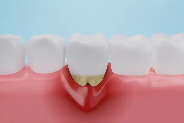 Close-up of a tooth with tartar buildup at the gum line, demonstrating the effects of untreated periodontal issues.