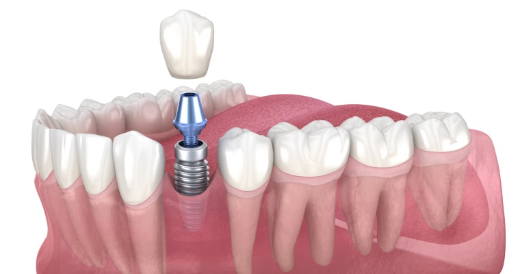 Dental implant illustration